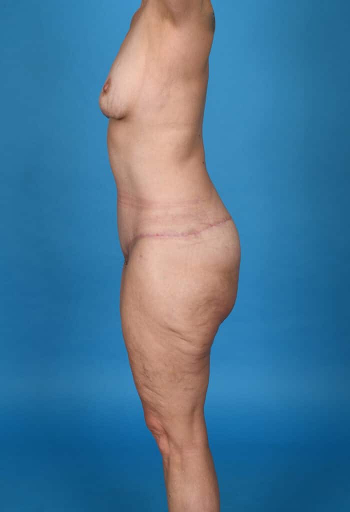 After Image: Tummy Tuck & Liposuction - left-side