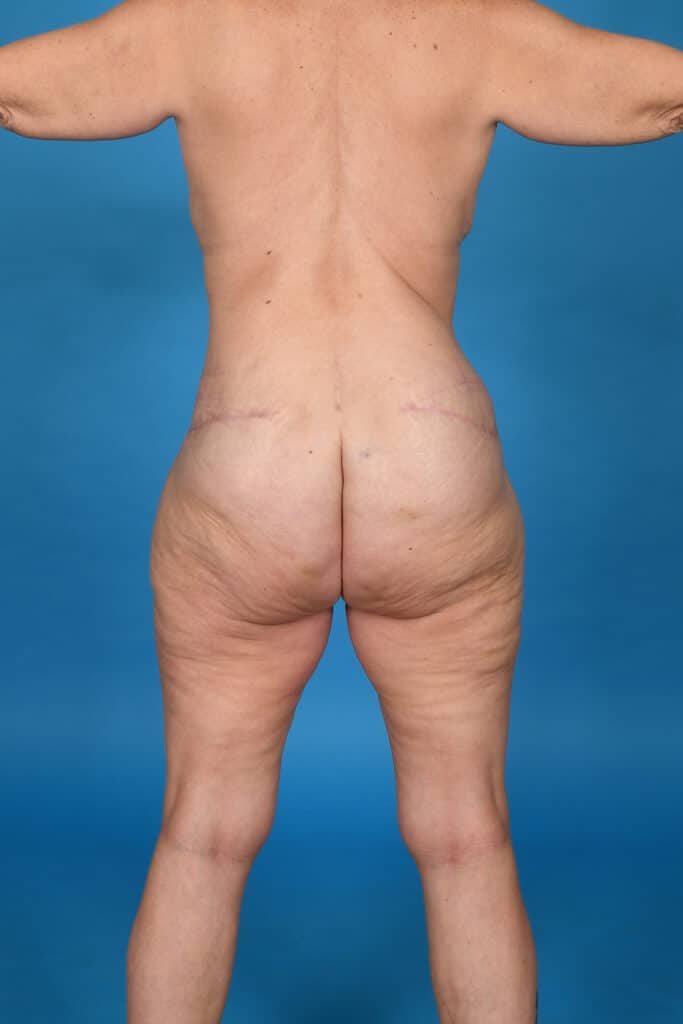 After Image: Tummy Tuck & Liposuction - back