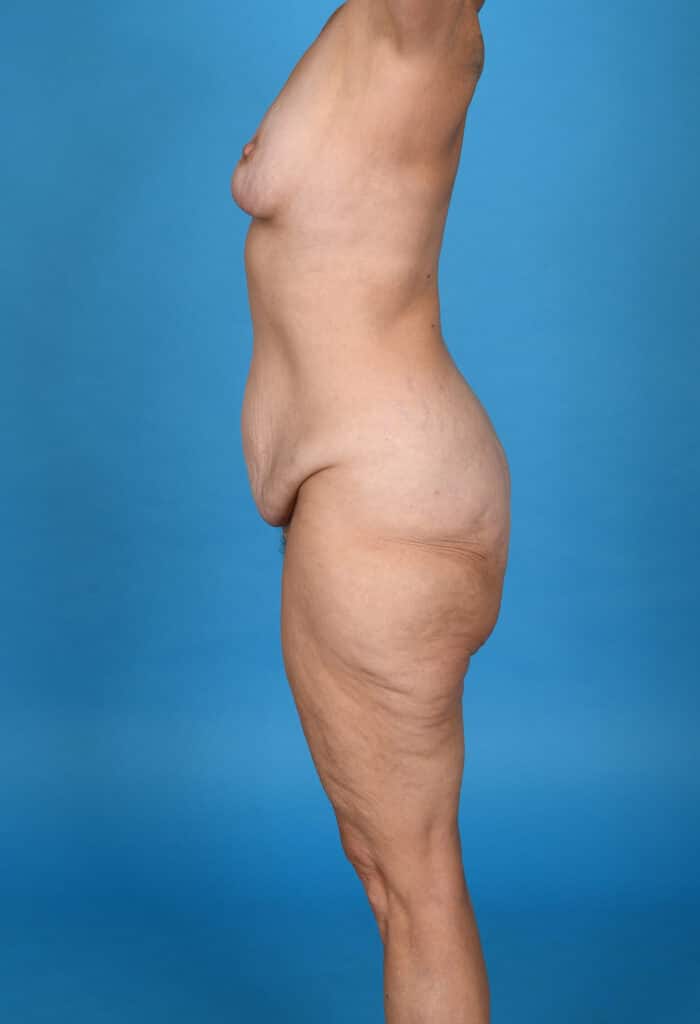 Before Image: Tummy Tuck & Liposuction - left-side