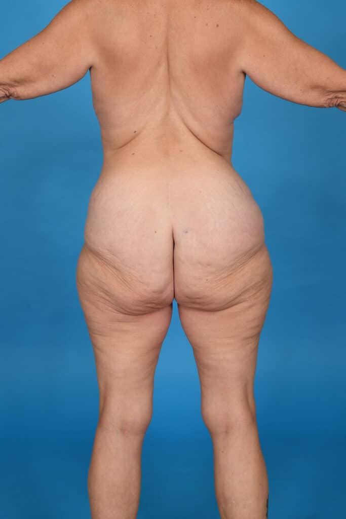 Before Image: Tummy Tuck & Liposuction - back