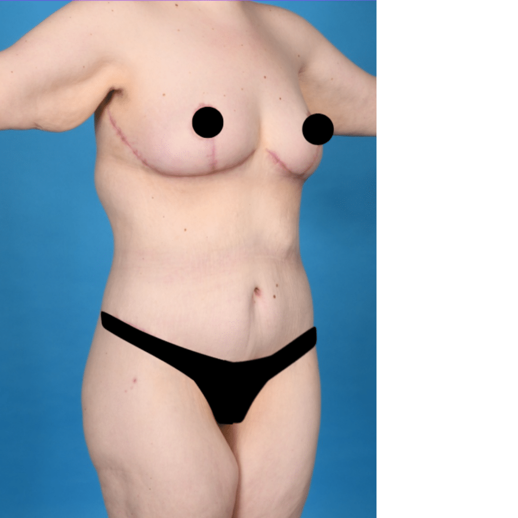 After Image: Extended abdominoplasty, breast lift (mastopexy) - right-front-oblique