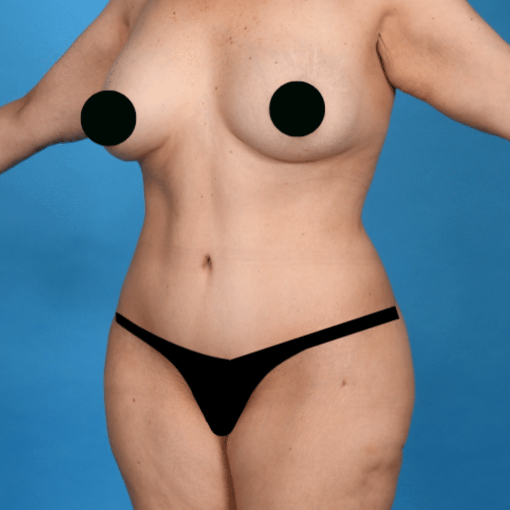 After Image: Extended abdominoplasty, Liposuction 360 - left-front-oblique