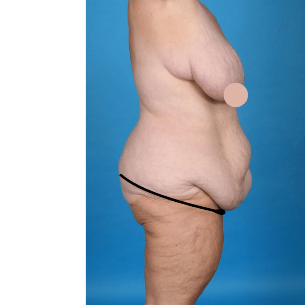 Before Image: Circumferential abdominoplasty, bilateral breast reduction, liposuction 360 - right-side
