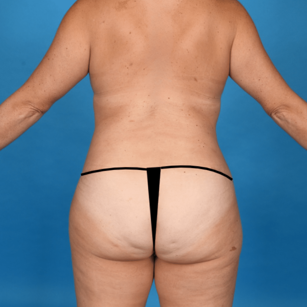 After Image: Extended abdominoplasty, liposuction 360 - back