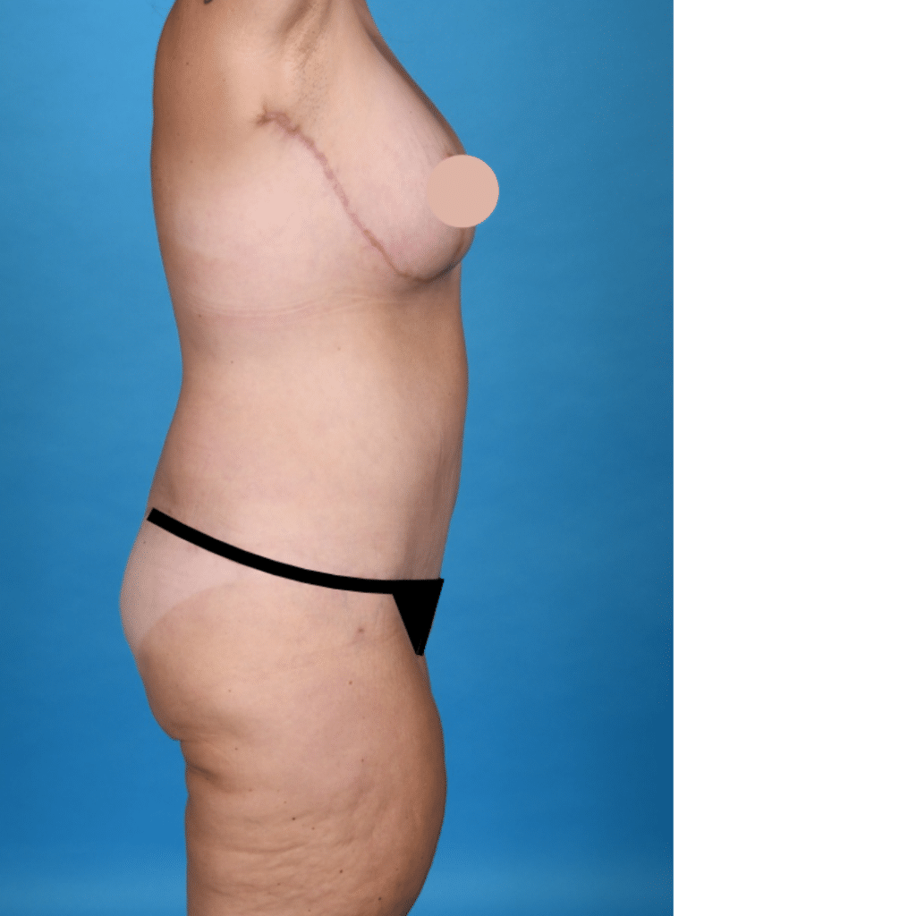 After Image: Circumferential abdominoplasty, bilateral breast reduction, liposuction 360 - right-side