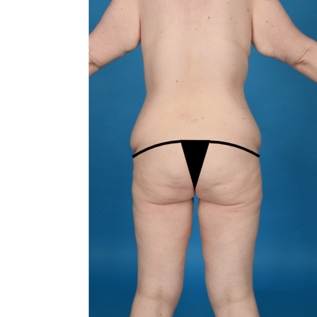 Before Image: Extended abdominoplasty, breast lift (mastopexy) - back