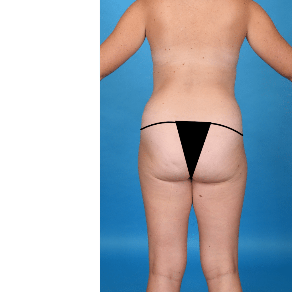 Before Image: Extended abdominoplasty, liposuction 360 - back