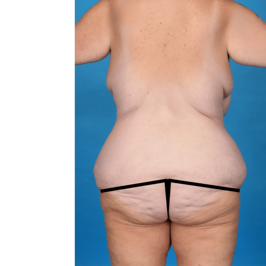 Before Image: Circumferential abdominoplasty, bilateral breast reduction, liposuction 360 - back