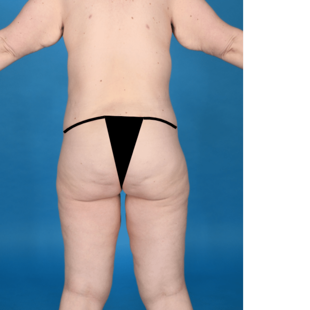 After Image: Extended abdominoplasty, breast lift (mastopexy) - back