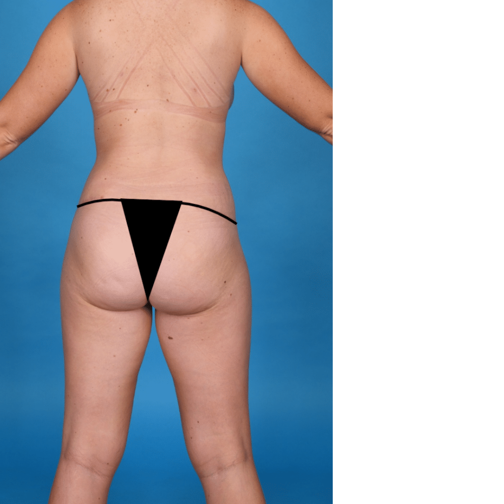 After Image: Extended abdominoplasty, liposuction 360 - back