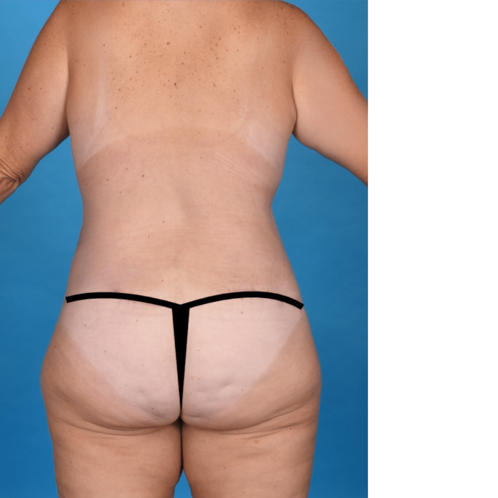 After Image: Circumferential abdominoplasty, bilateral breast reduction, liposuction 360 - back