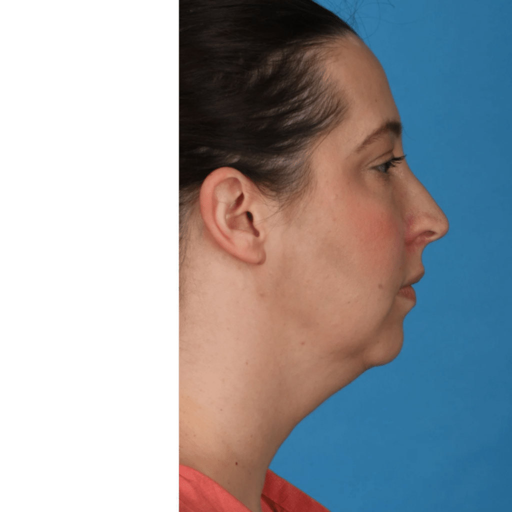 Before Image: Submental (under chin) Liposuction - right-side
