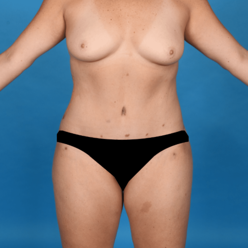 After Image: Extended abdominoplasty, liposuction 360 - front