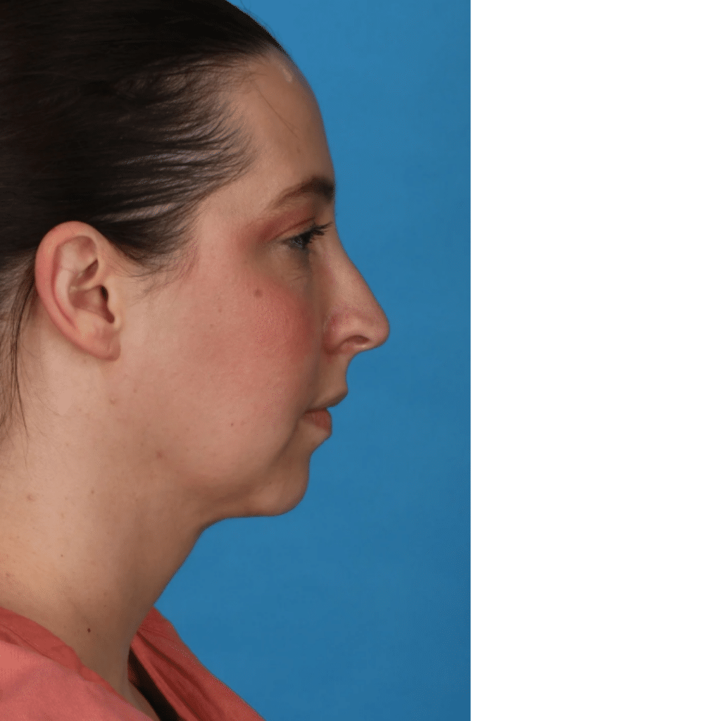 After Image: Submental (under chin) Liposuction - right-side