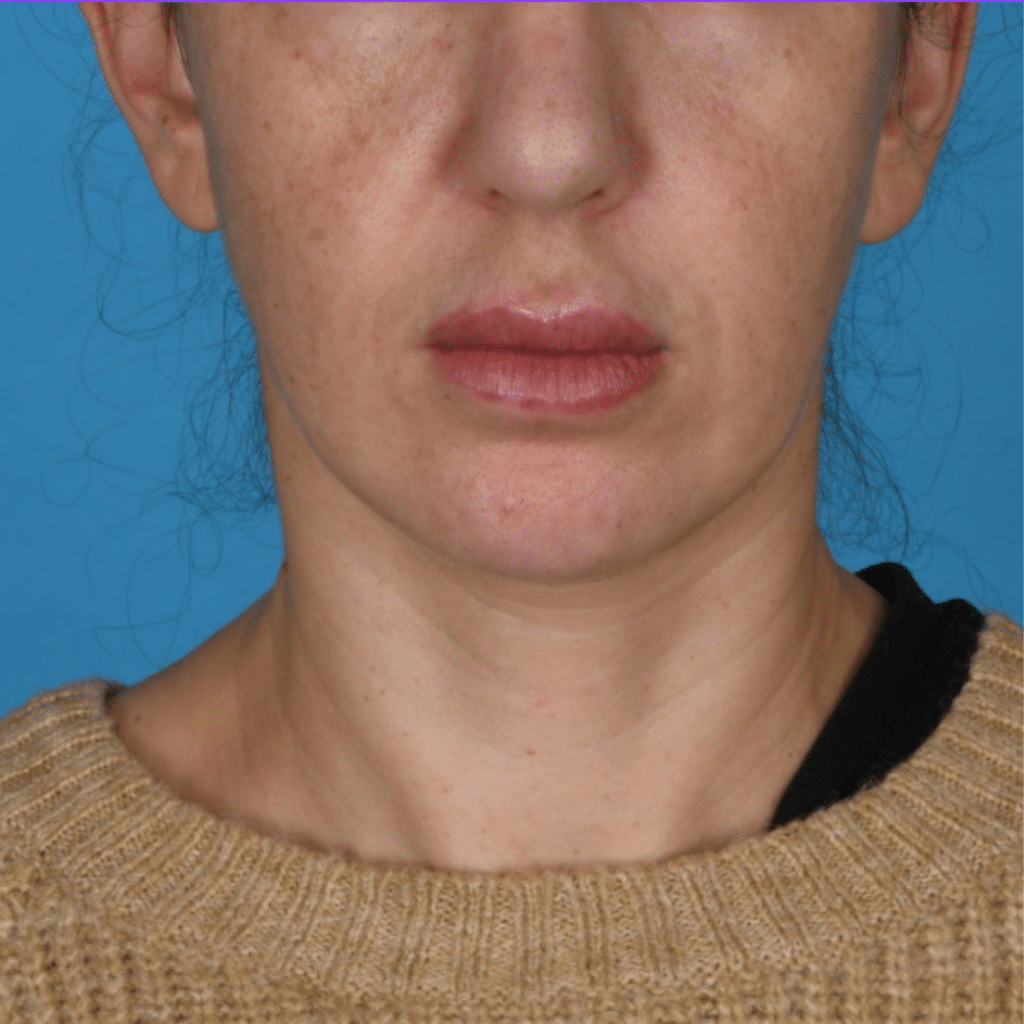 Before Image: Facelift/necklift - front