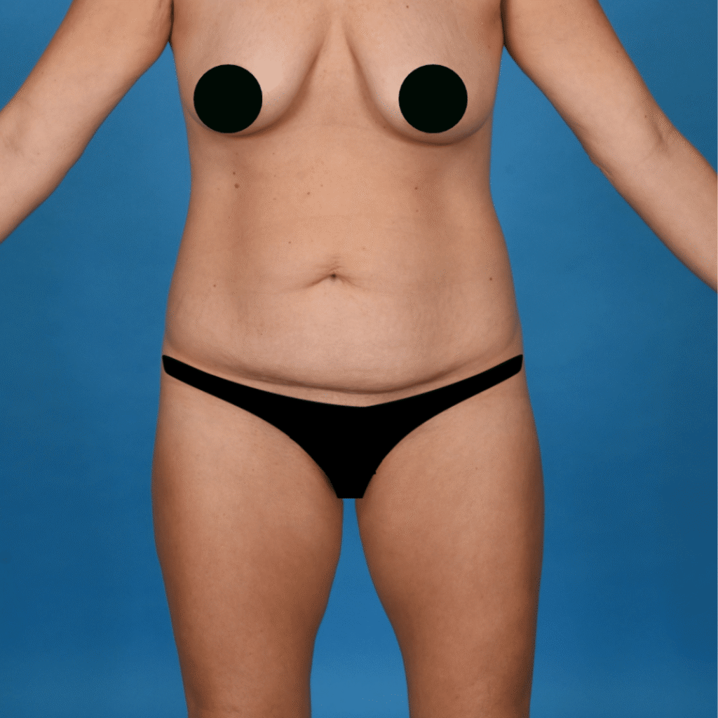 Before Image: Abdominoplasty, liposuction 360 - front