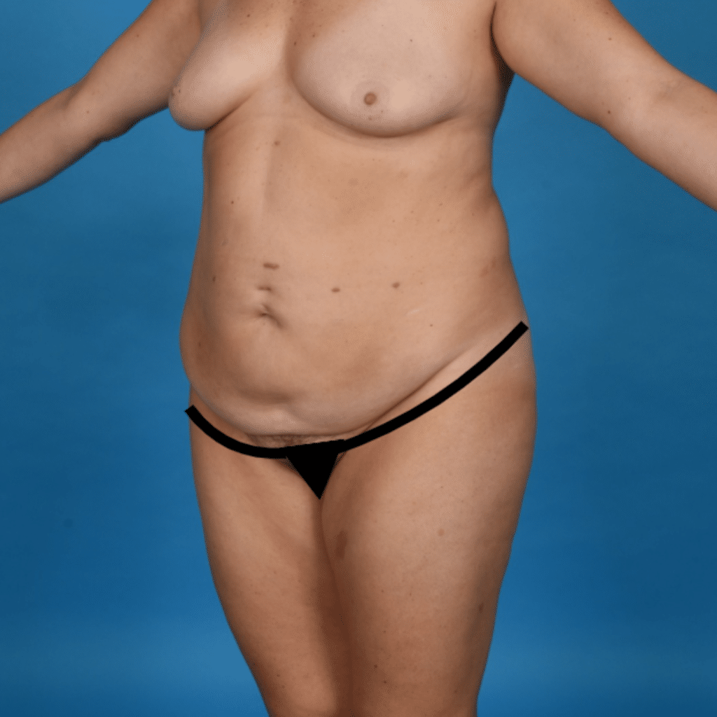Before Image: Extended abdominoplasty, liposuction 360 - left-front-oblique