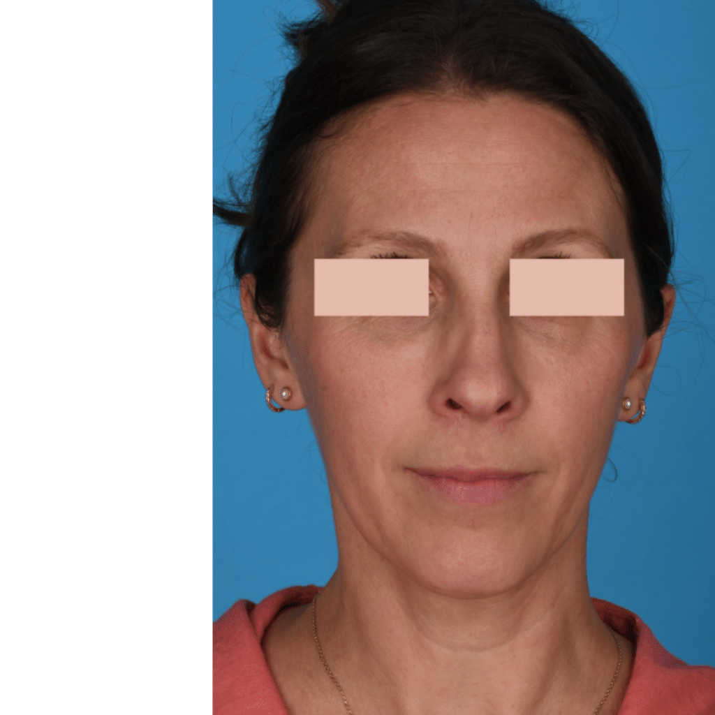 Before Image: Revision Rhinoplasty - front