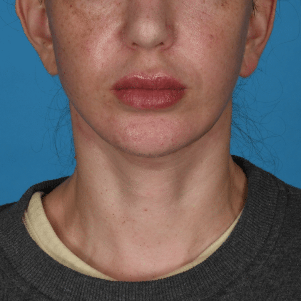 After Image: Facelift/necklift - front