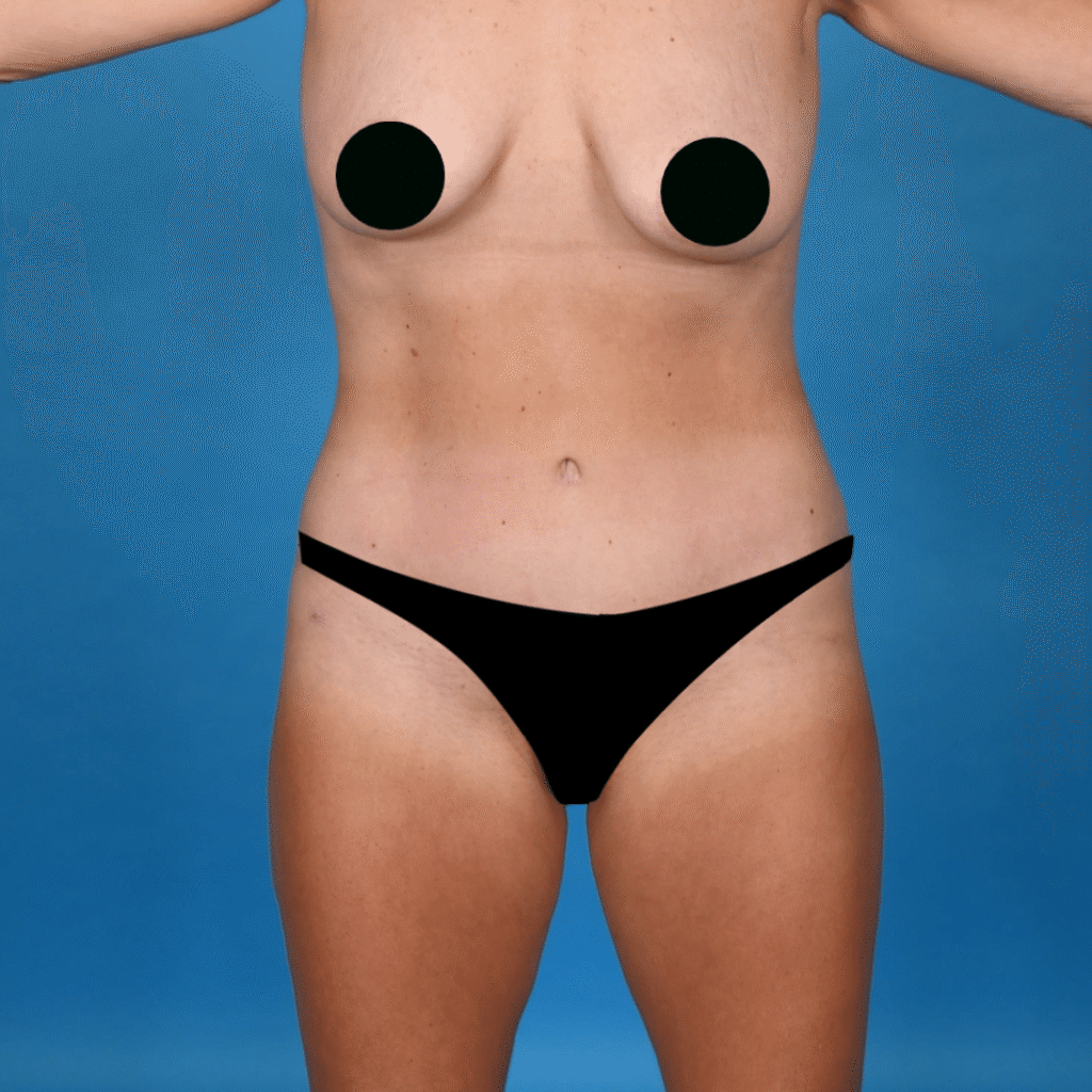 After Image: Abdominoplasty, liposuction 360 - front