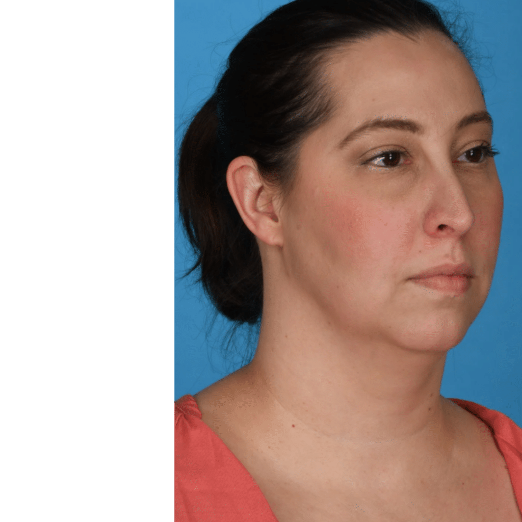Before Image: Submental (under chin) Liposuction - right-front-oblique