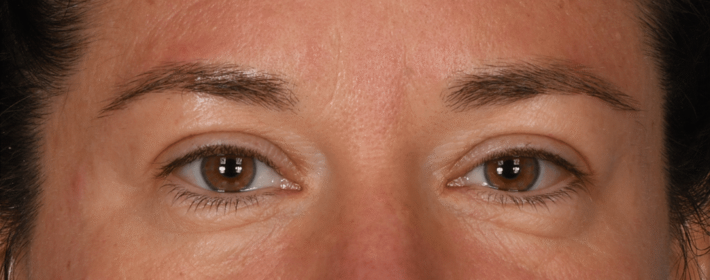 Before Image: Lower blepharoplasty - front
