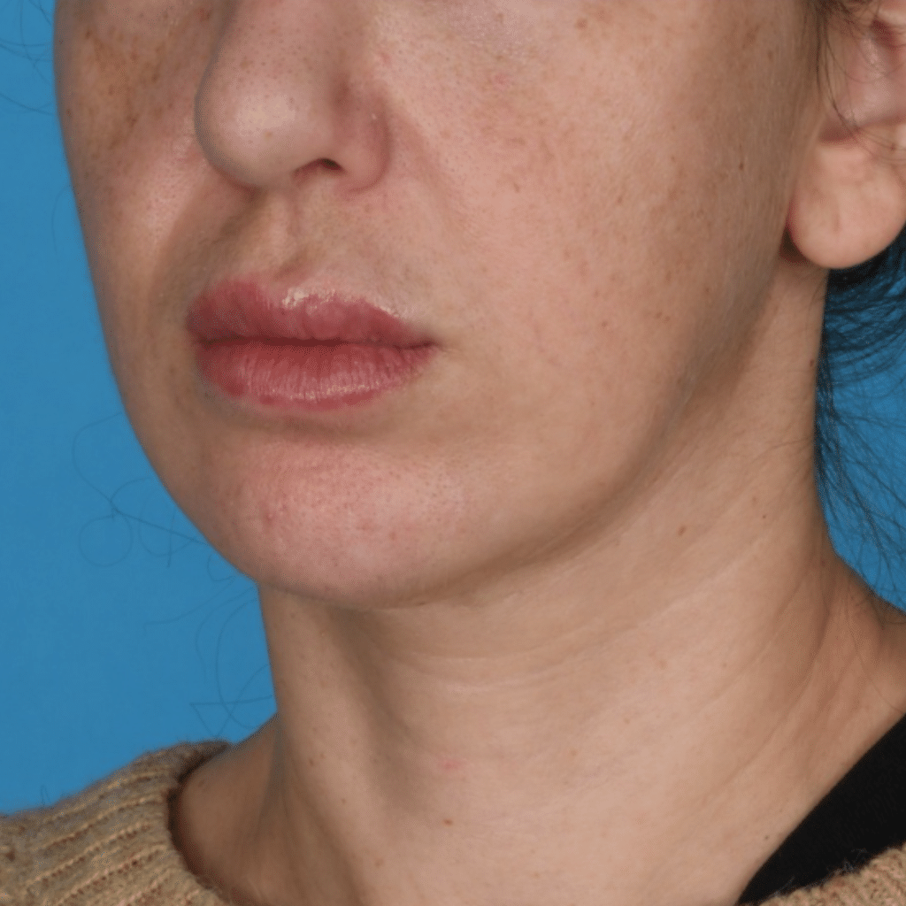 Before Image: Facelift/necklift - left-front-oblique