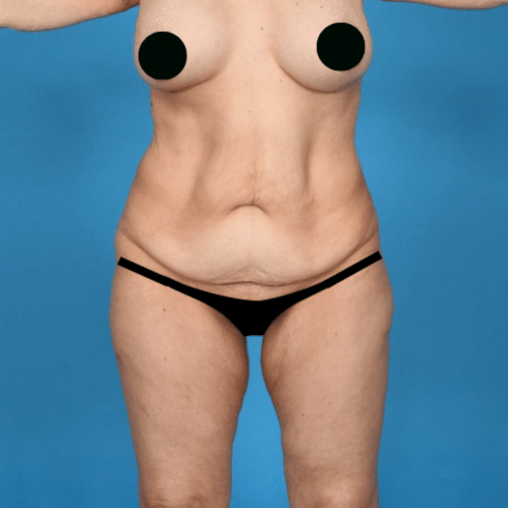 Before Image: Extended abdominoplasty, Liposuction 360 - front