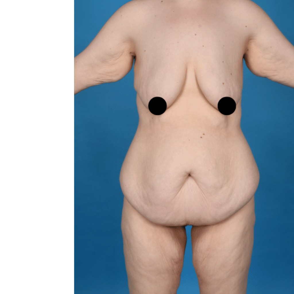 Before Image: Extended abdominoplasty, breast lift (mastopexy) - front