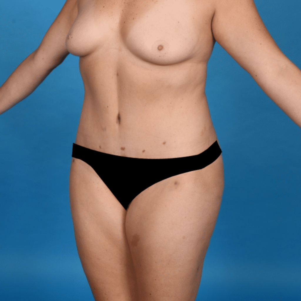 After Image: Extended abdominoplasty, liposuction 360 - left-front-oblique