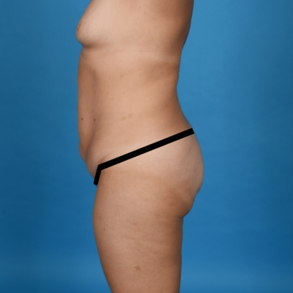 Before Image: Extended abdominoplasty, liposuction 360 - left-side