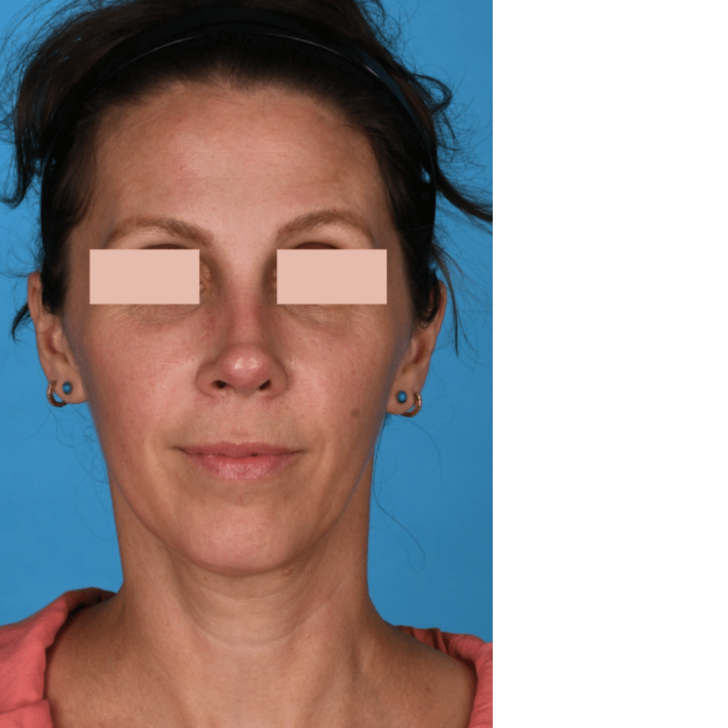 After Image: Revision Rhinoplasty - front