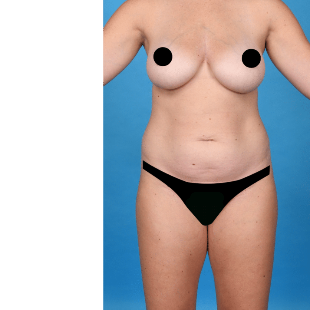 Before Image: Extended abdominoplasty, liposuction 360 - front