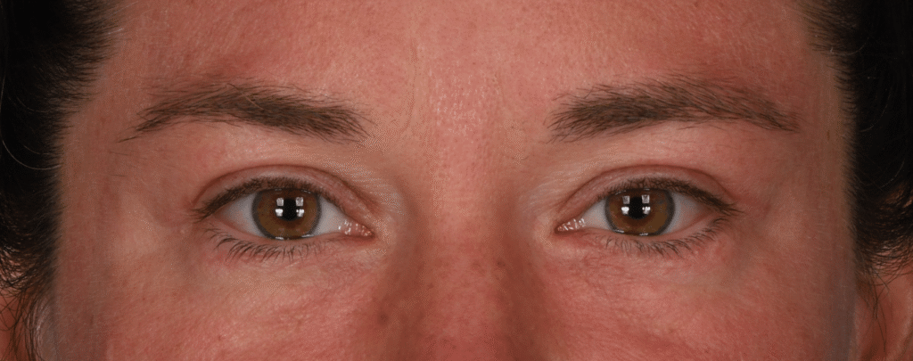 After Image: Lower blepharoplasty - front