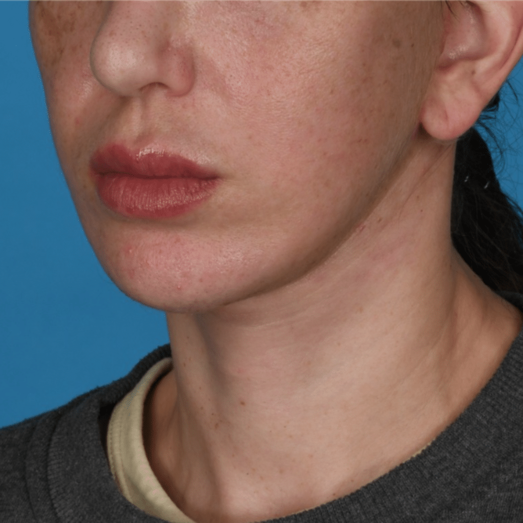 After Image: Facelift/necklift - left-front-oblique