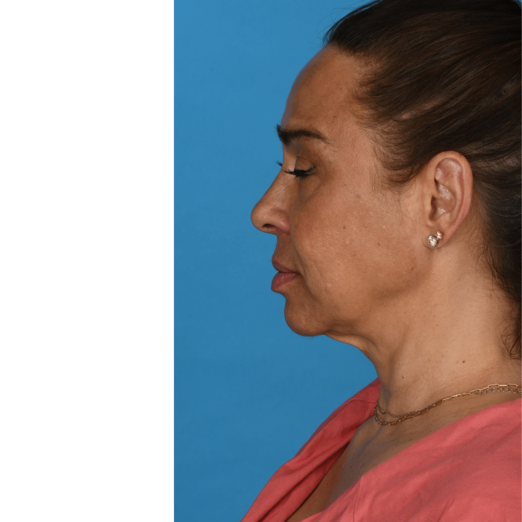 Before Image: Facelift, necklift, upper blepharoplasty - left-side