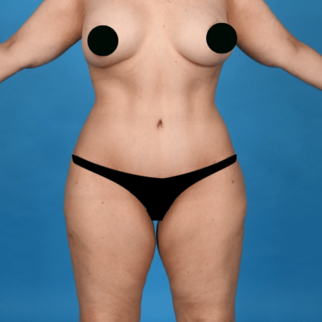 After Image: Extended abdominoplasty, Liposuction 360 - front