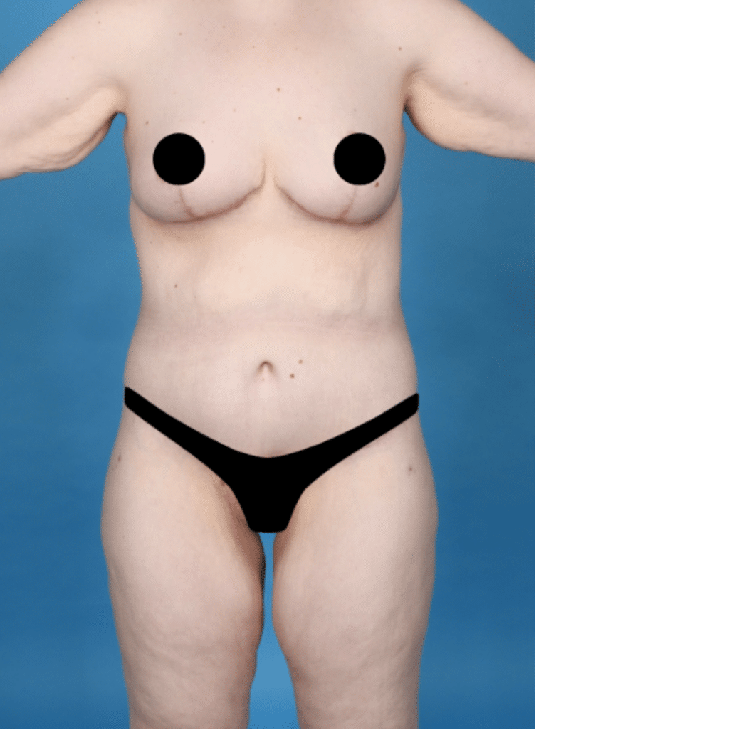 After Image: Extended abdominoplasty, breast lift (mastopexy) - front