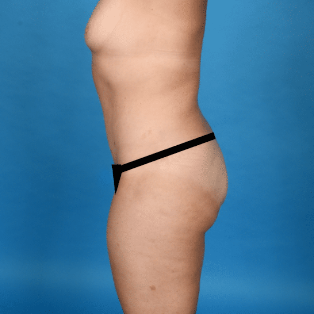 After Image: Extended abdominoplasty, liposuction 360 - left-side