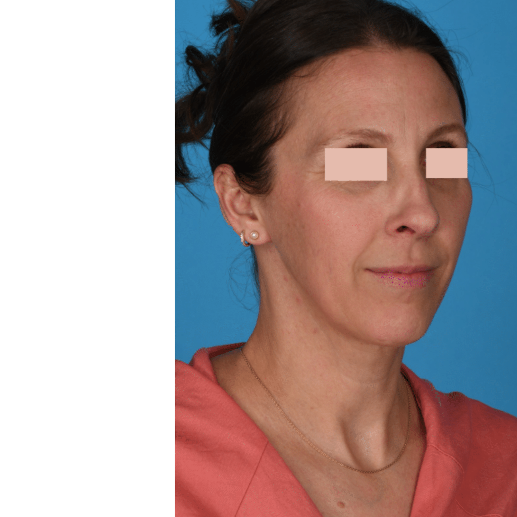 Before Image: Revision Rhinoplasty - front