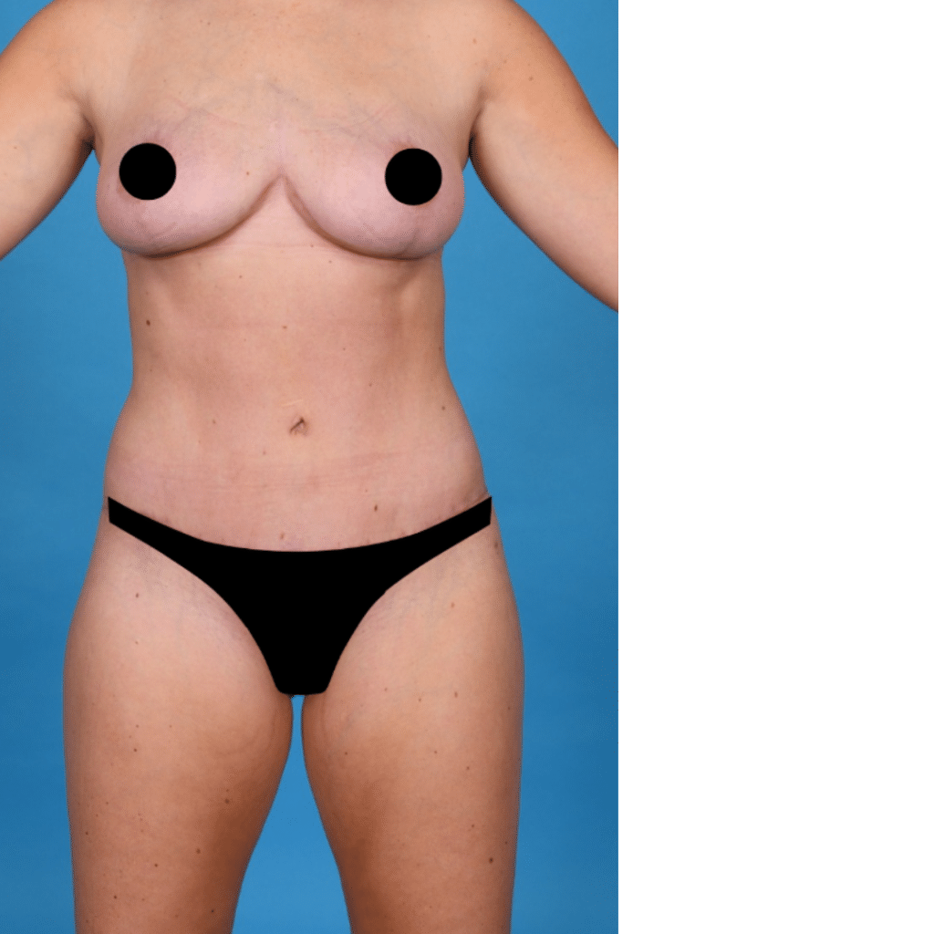 After Image: Extended abdominoplasty, liposuction 360 - front