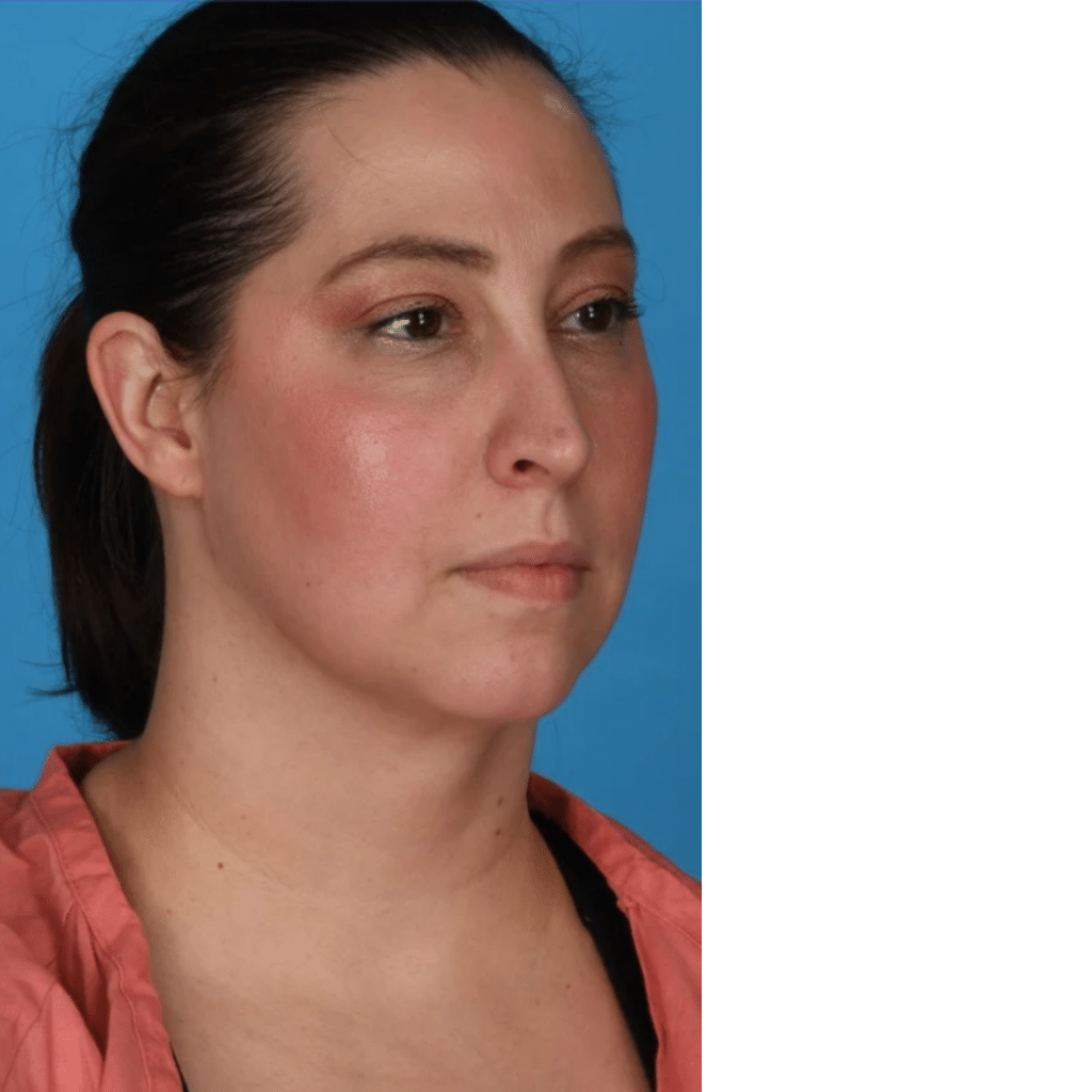 After Image: Submental (under chin) Liposuction - right-front-oblique