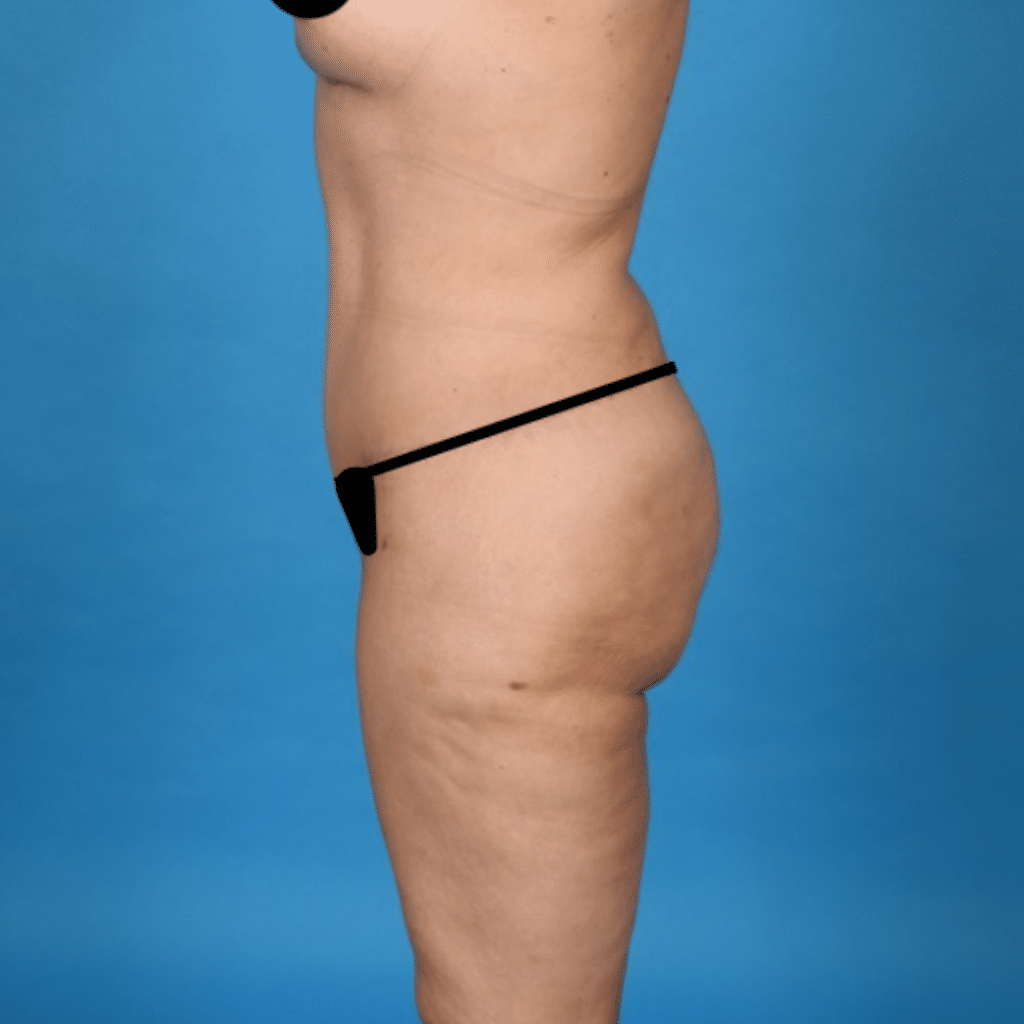 After Image: Extended abdominoplasty, Liposuction 360 - left-side