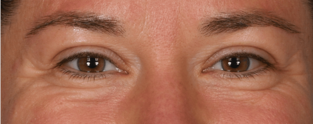 Before Image: Lower blepharoplasty - front