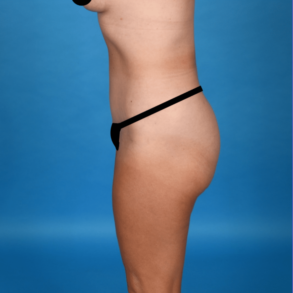 After Image: Abdominoplasty, liposuction 360 - left-side