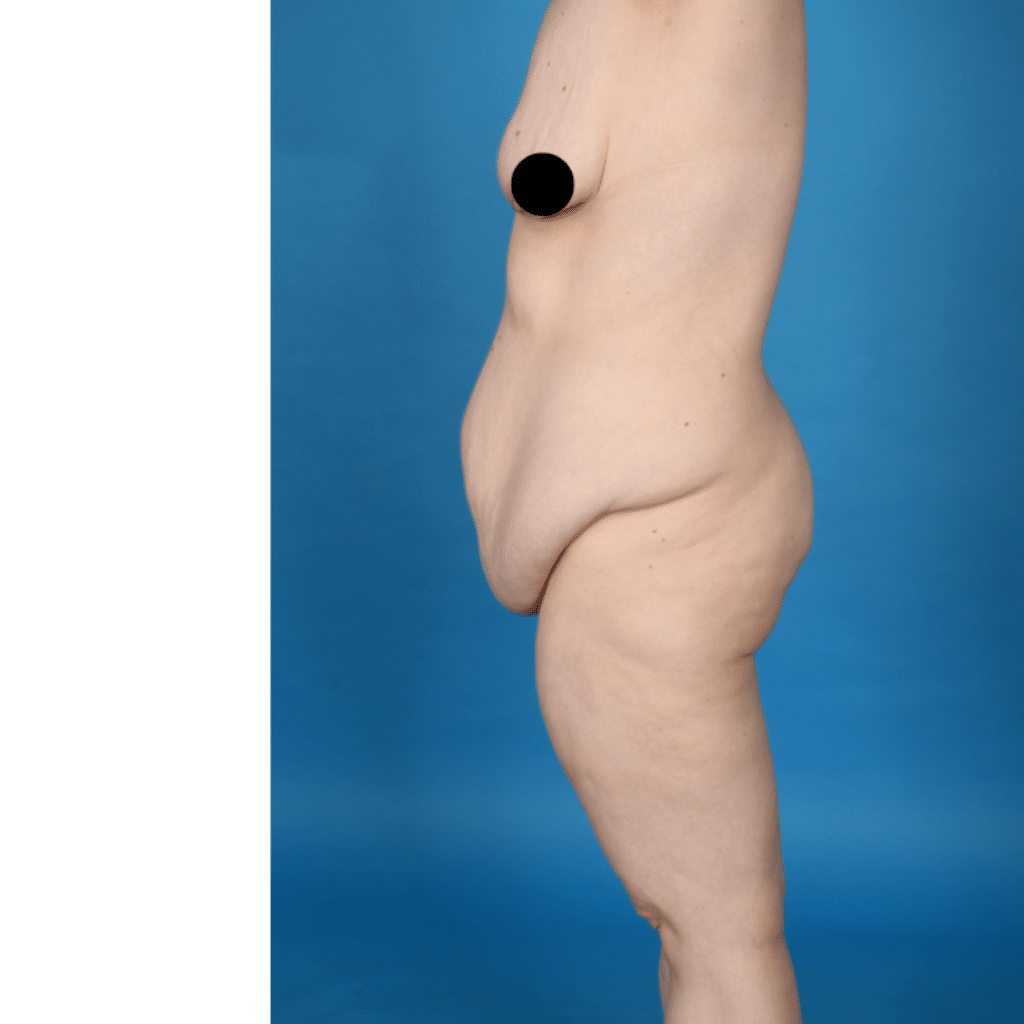 Before Image: Extended abdominoplasty, breast lift (mastopexy) - left-side