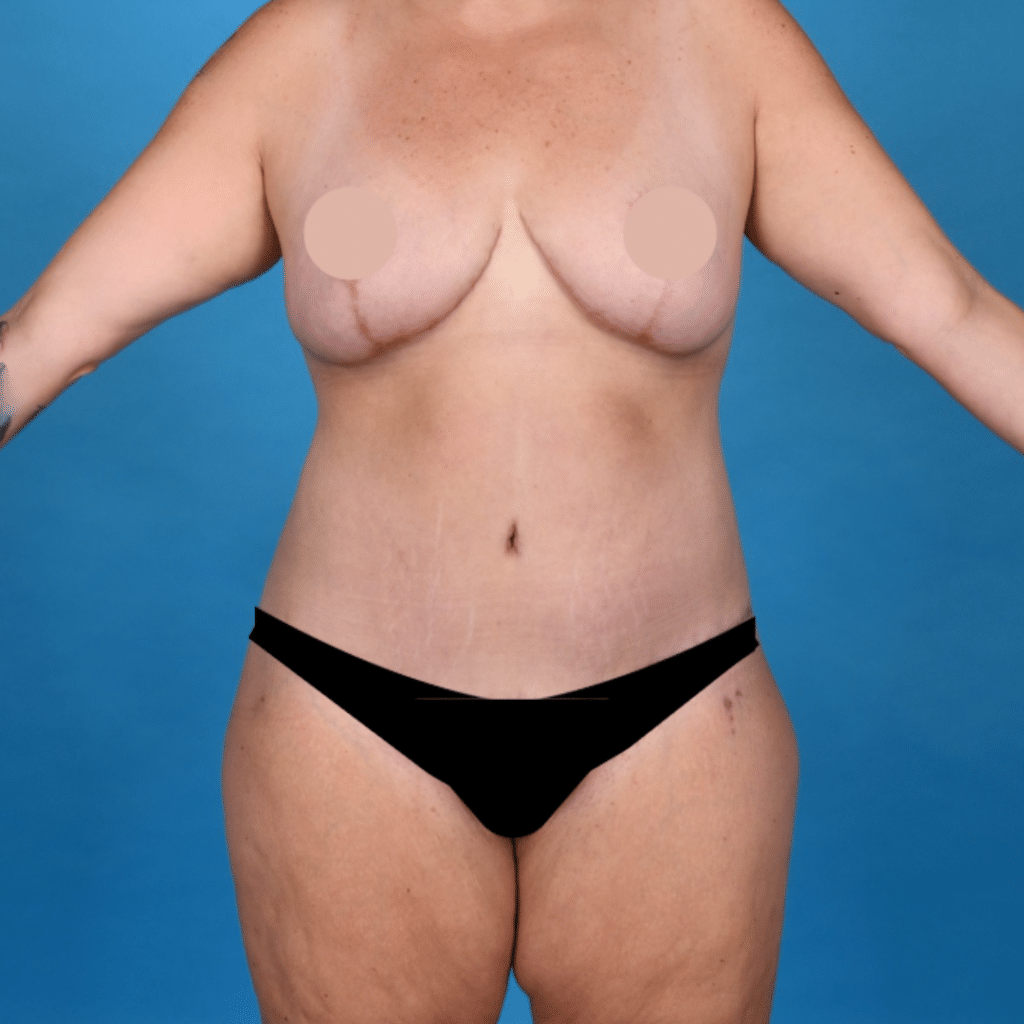 After Image: Circumferential abdominoplasty, bilateral breast reduction, liposuction 360 - left-front-oblique