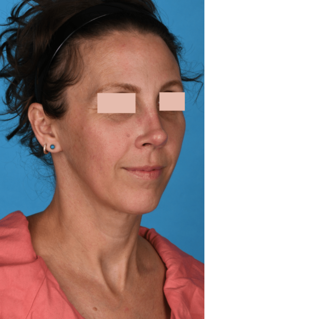 After Image: Revision Rhinoplasty - front