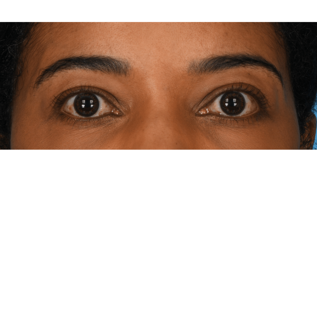 Before Image: Upper blepharoplasty - front