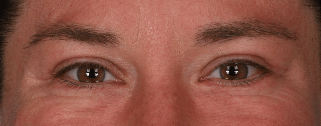 After Image: Lower blepharoplasty - front